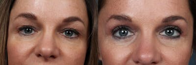 Eyelid Surgery Before & After Gallery - Patient 162531 - Image 1