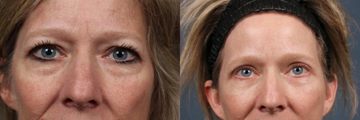 Eyelid Surgery Before & After Gallery - Patient 160474 - Image 1