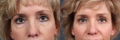 Eyelid Surgery Before & After Gallery - Patient 180374 - Image 1
