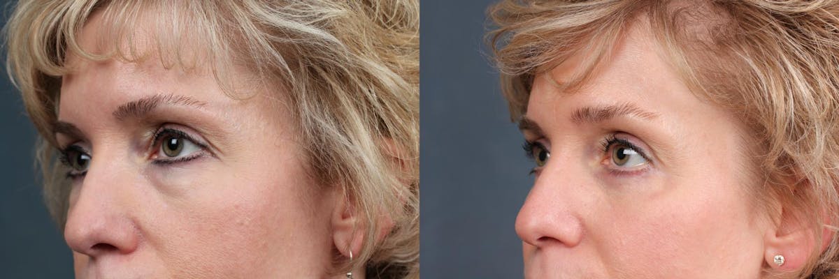 Eyelid Surgery Before & After Gallery - Patient 180374 - Image 2