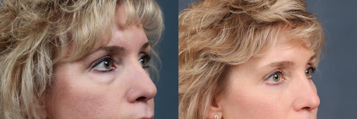 Eyelid Surgery Before & After Gallery - Patient 180374 - Image 3
