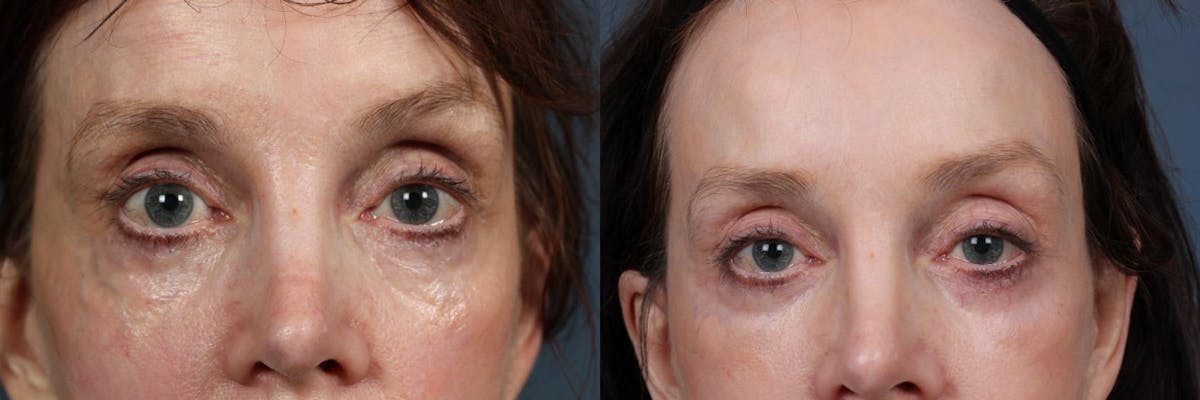 Eyelid Surgery Before & After Gallery - Patient 217681 - Image 1