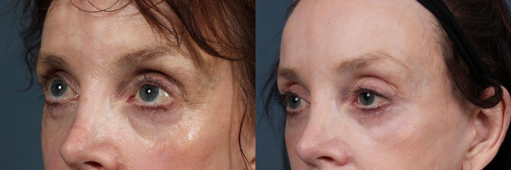 Eyelid Surgery Before & After Gallery - Patient 217681 - Image 2