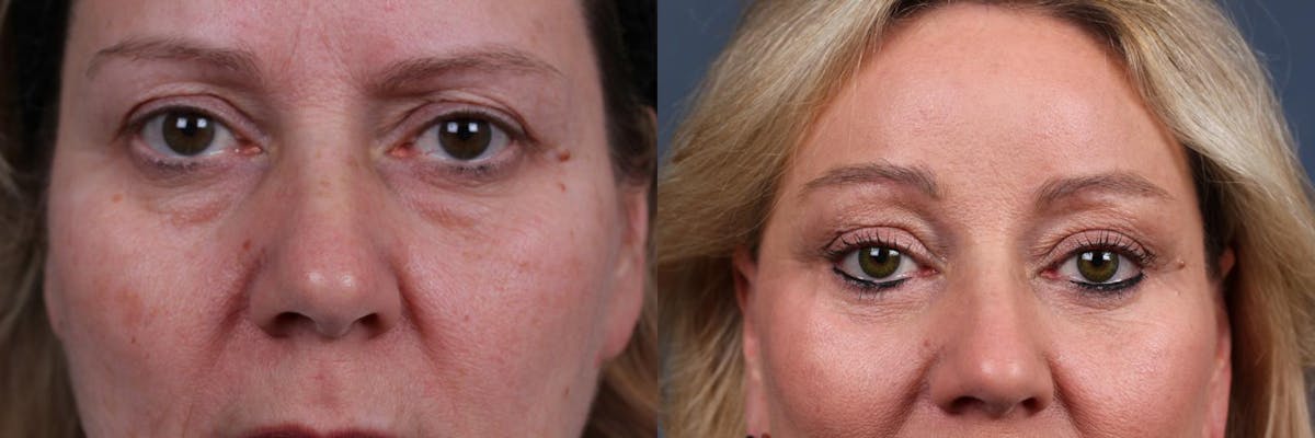 Eyelid Surgery Before & After Gallery - Patient 793394 - Image 1