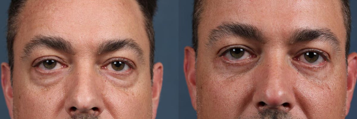 Eyelid Surgery Before & After Gallery - Patient 351978 - Image 1