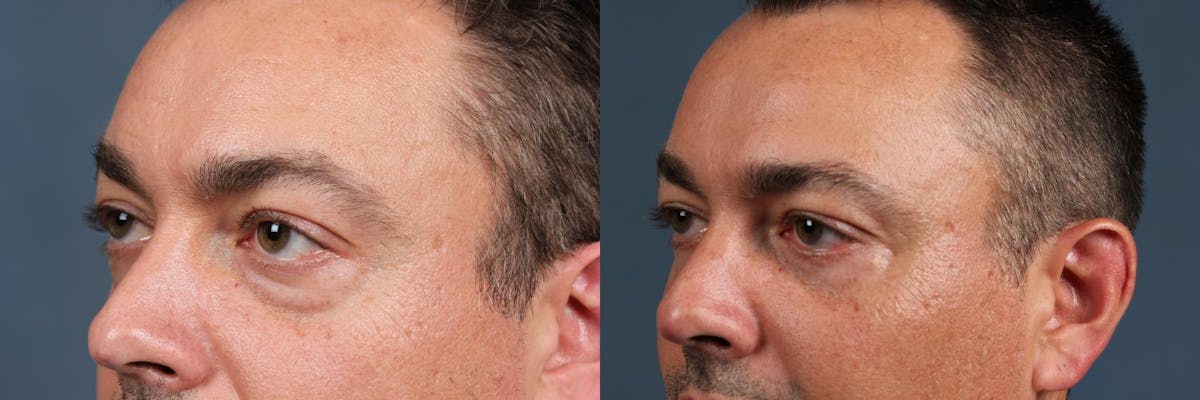 Eyelid Surgery Before & After Gallery - Patient 351978 - Image 3