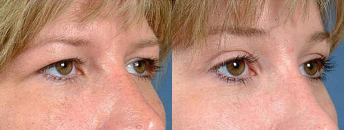 Eyelid Surgery Before & After Gallery - Patient 878834 - Image 2