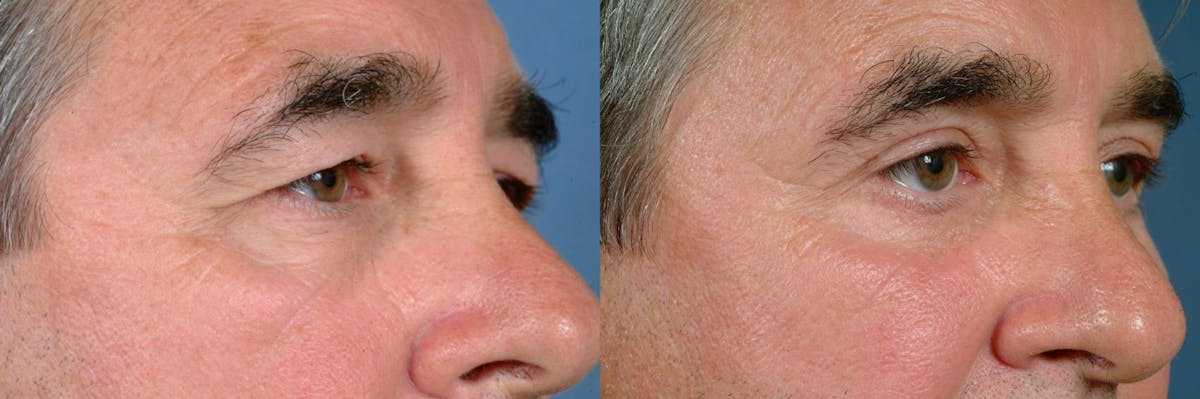 Blepharoplasty Before & After Gallery - Patient 235063 - Image 2