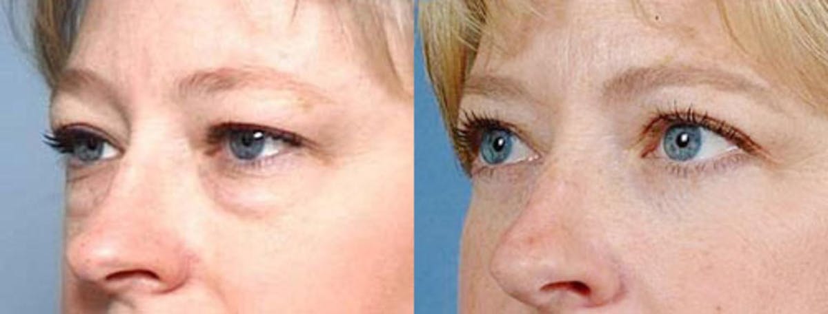 Eyelid Surgery Before & After Gallery - Patient 576564 - Image 2