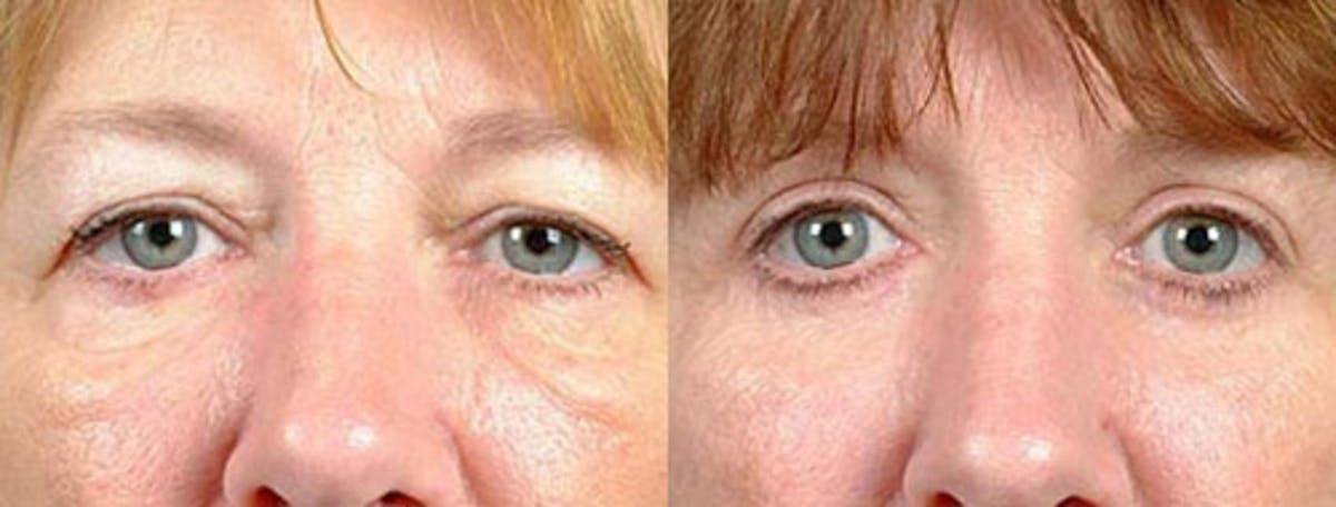 Eyelid Surgery Before & After Gallery - Patient 396990 - Image 1