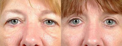 Eyelid Surgery Before & After Gallery - Patient 396990 - Image 1