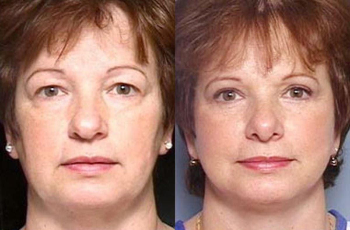 Eyelid Surgery Before & After Gallery - Patient 137652 - Image 1