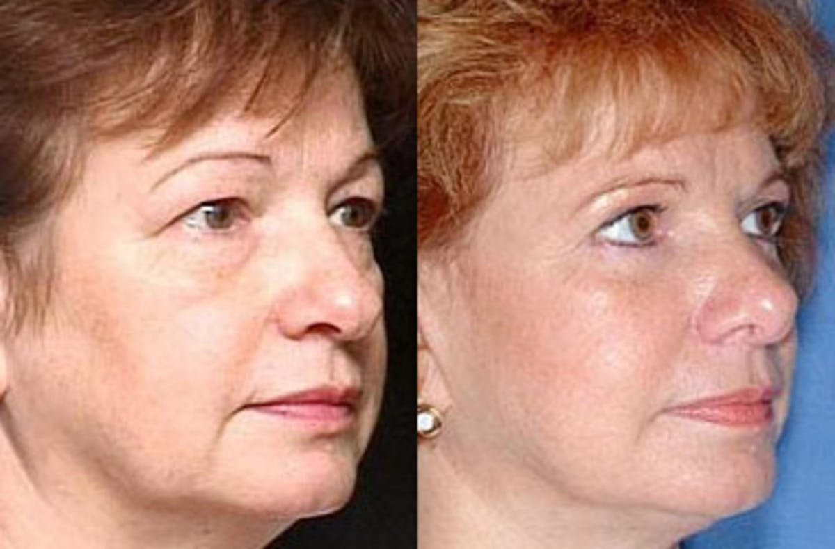 Eyelid Surgery Before & After Gallery - Patient 137652 - Image 2