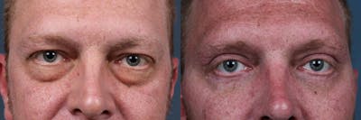 Eyelid Surgery Before & After Gallery - Patient 346060 - Image 1