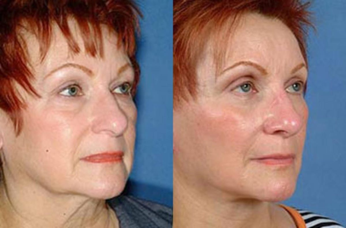 Eyelid Surgery Before & After Gallery - Patient 228822 - Image 2