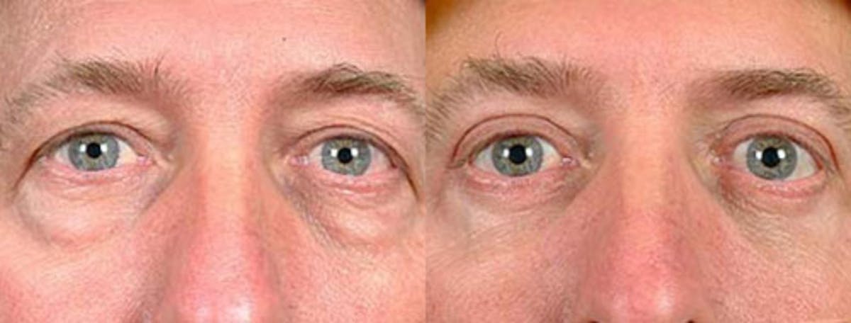 Eyelid Surgery Before & After Gallery - Patient 112429 - Image 1