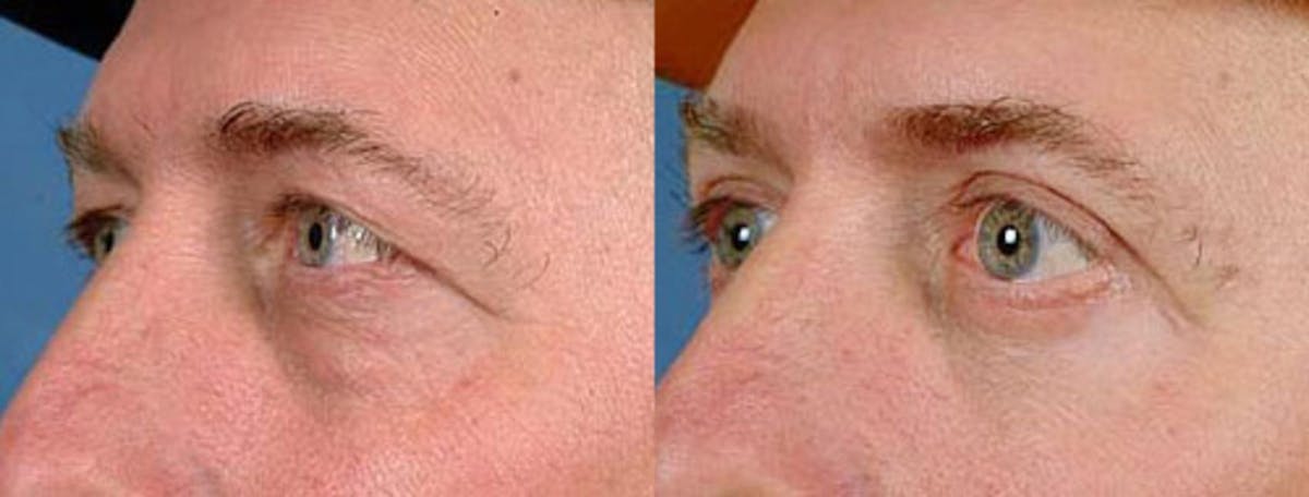 Eyelid Surgery Before & After Gallery - Patient 112429 - Image 2