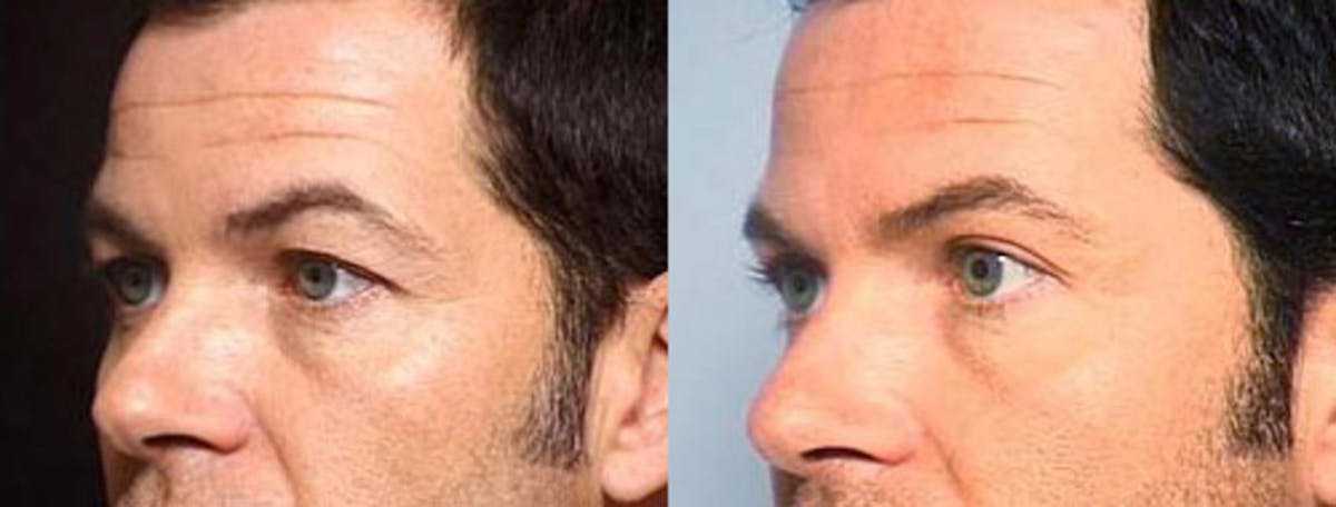 Eyelid Surgery Before & After Gallery - Patient 383167 - Image 2