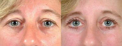 Eyelid Surgery Before & After Gallery - Patient 413833 - Image 1