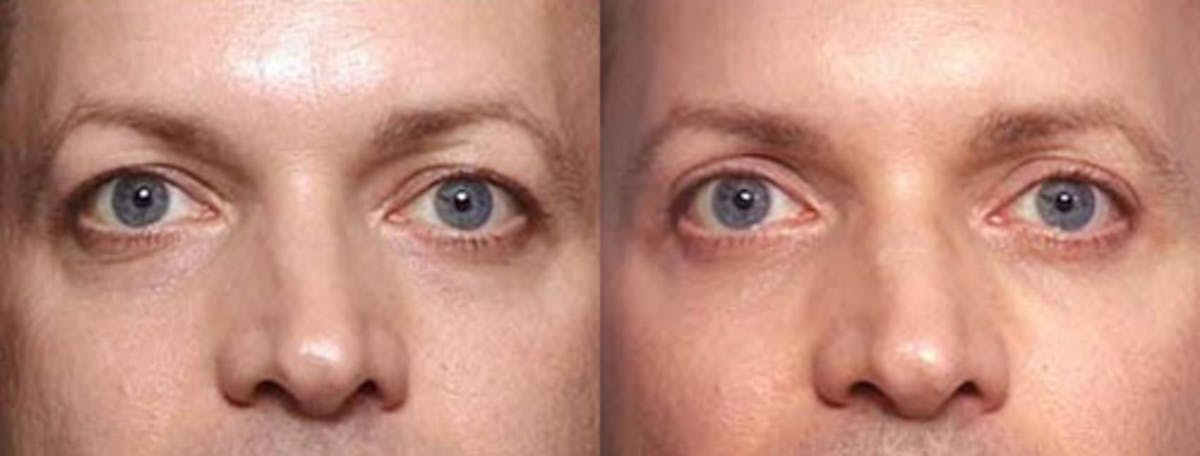 Eyelid Surgery Before & After Gallery - Patient 313997 - Image 1