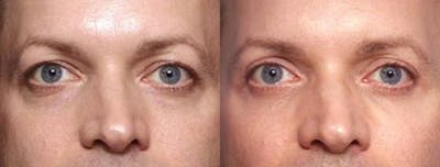 Eyelid Surgery Before & After Gallery - Patient 313997 - Image 1