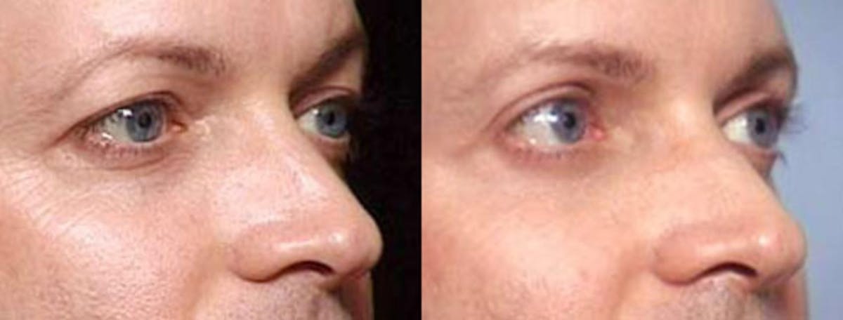 Eyelid Surgery Before & After Gallery - Patient 313997 - Image 2