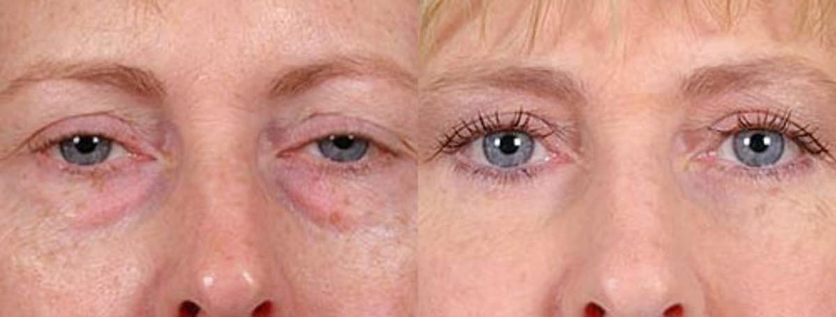 Eyelid Surgery Before & After Gallery - Patient 103276 - Image 1