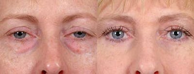 Eyelid Surgery Before & After Gallery - Patient 103276 - Image 1