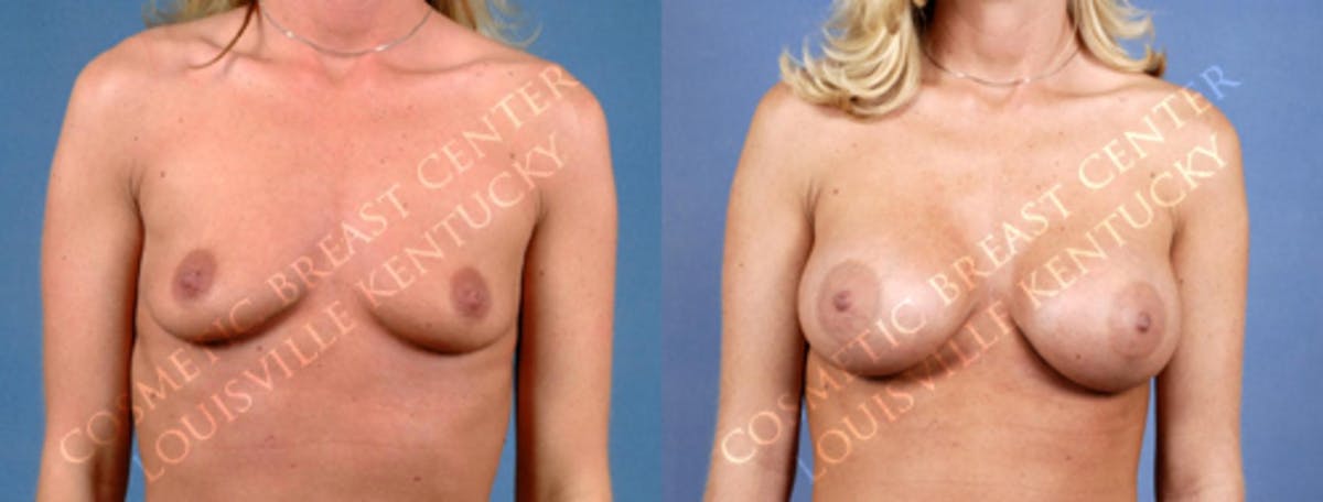 Enlargement - Saline Before & After Gallery - Patient 342578 - Image 1