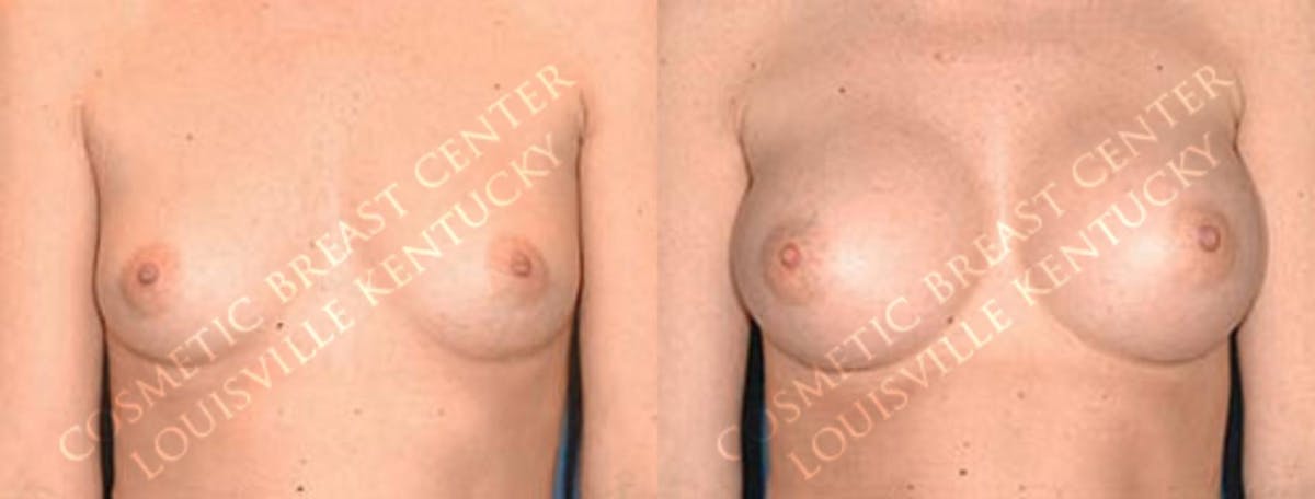 Enlargement - Saline Before & After Gallery - Patient 634225 - Image 1
