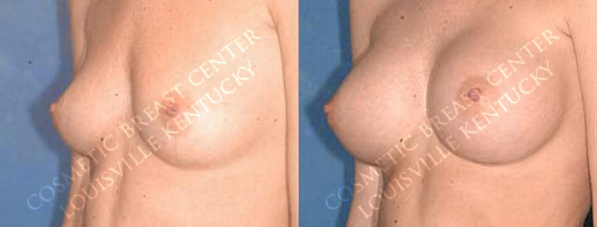 Enlargement - Saline Before & After Gallery - Patient 634225 - Image 2