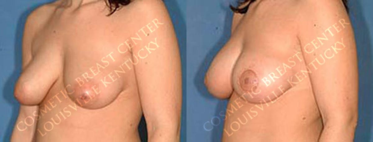 Enlargement - Saline Before & After Gallery - Patient 122492 - Image 2