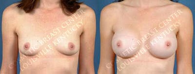 Enlargement - Saline Before & After Gallery - Patient 184446 - Image 1