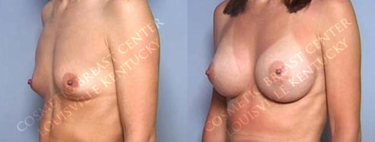 Enlargement - Saline Before & After Gallery - Patient 293156 - Image 2