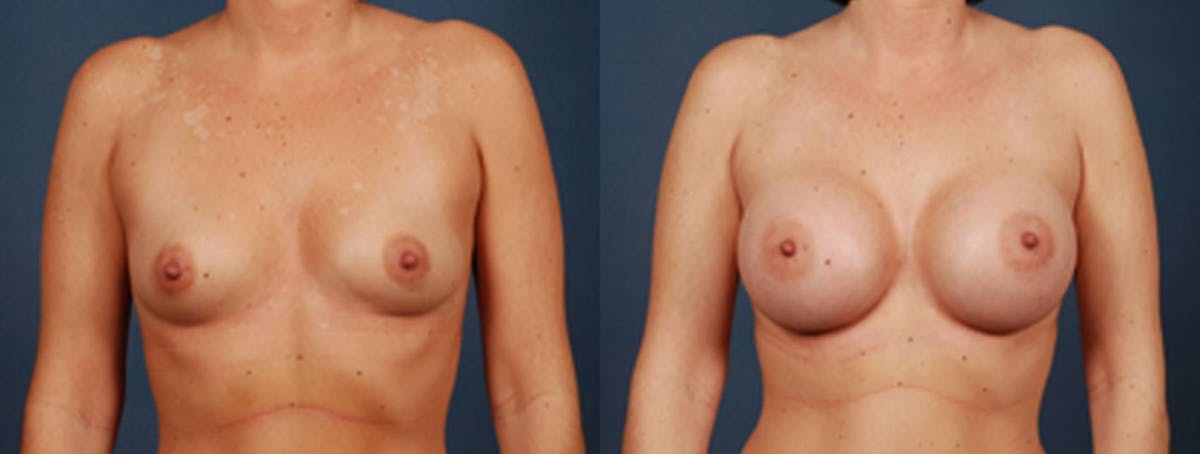 Enlargement - Saline Before & After Gallery - Patient 269861 - Image 1