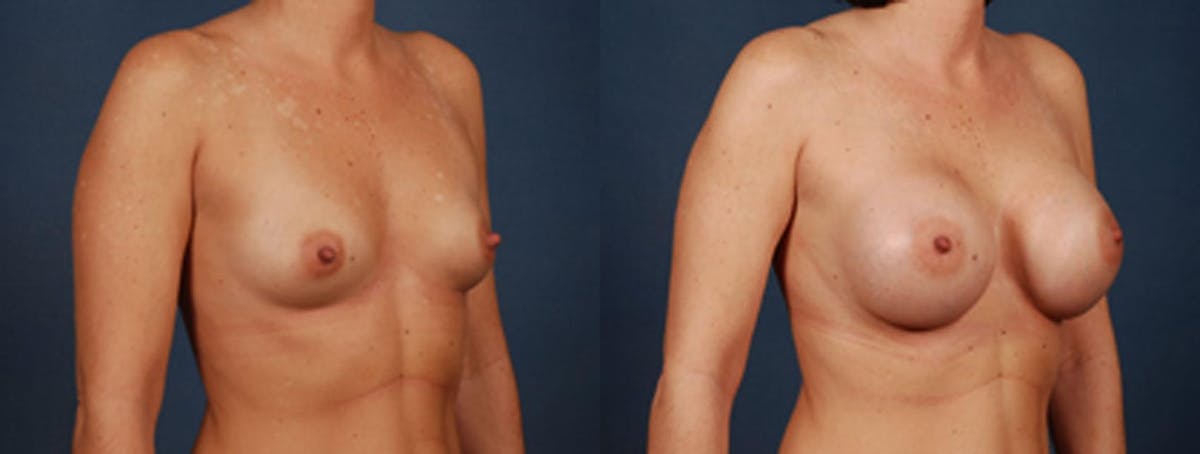 Enlargement - Saline Before & After Gallery - Patient 269861 - Image 2