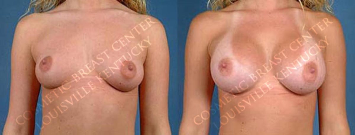Enlargement - Saline Before & After Gallery - Patient 363919 - Image 1