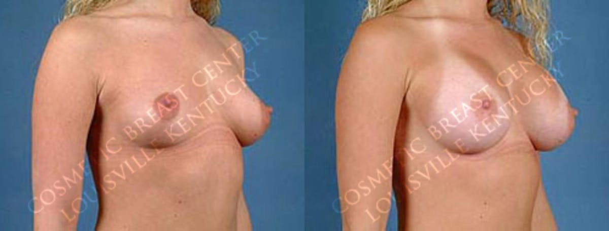 Enlargement - Saline Before & After Gallery - Patient 363919 - Image 2