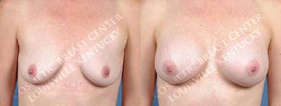 Enlargement - Saline Before & After Gallery - Patient 249309 - Image 1