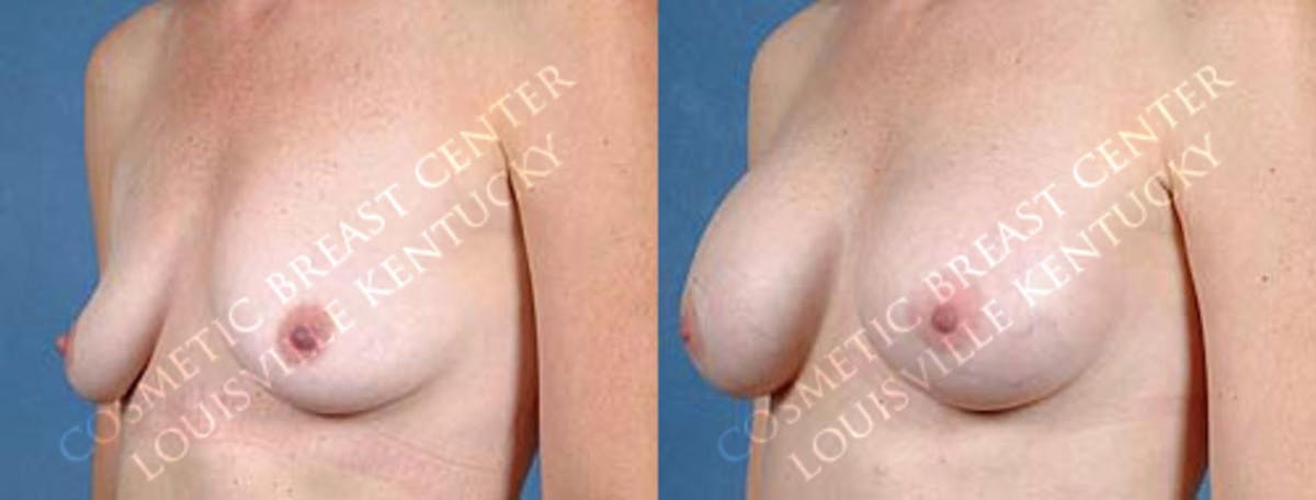 Enlargement - Saline Before & After Gallery - Patient 249309 - Image 2