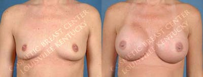 Enlargement - Saline Before & After Gallery - Patient 379290 - Image 1