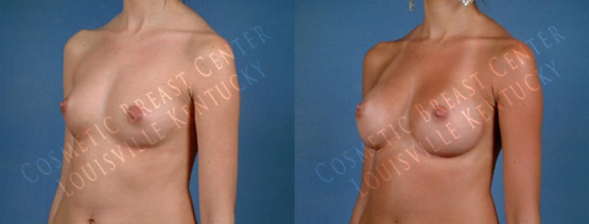 Enlargement - Saline Before & After Gallery - Patient 408311 - Image 2