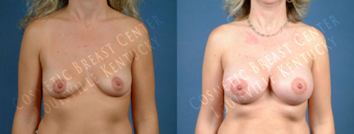 Enlargement - Saline Before & After Gallery - Patient 514274 - Image 1