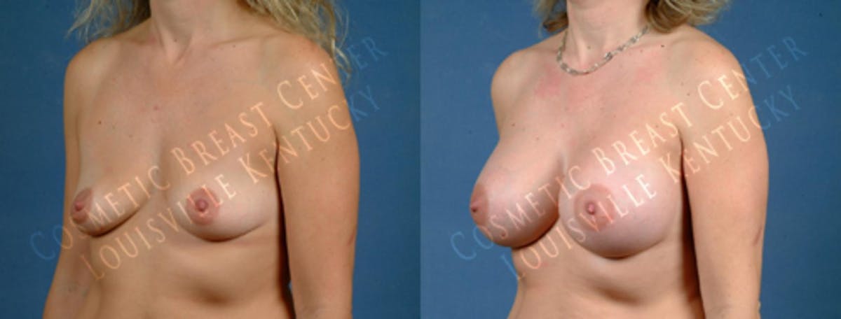 Enlargement - Saline Before & After Gallery - Patient 514274 - Image 2