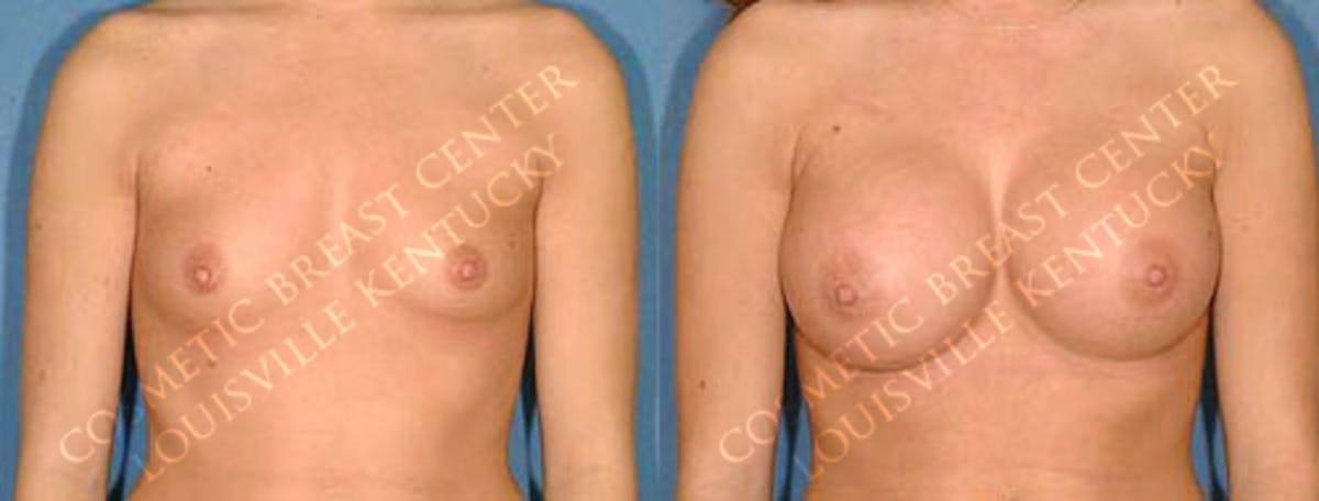 Enlargement - Saline Before & After Gallery - Patient 114392 - Image 1