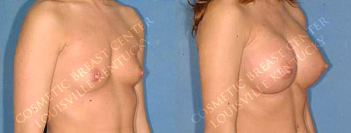 Enlargement - Saline Before & After Gallery - Patient 114392 - Image 2