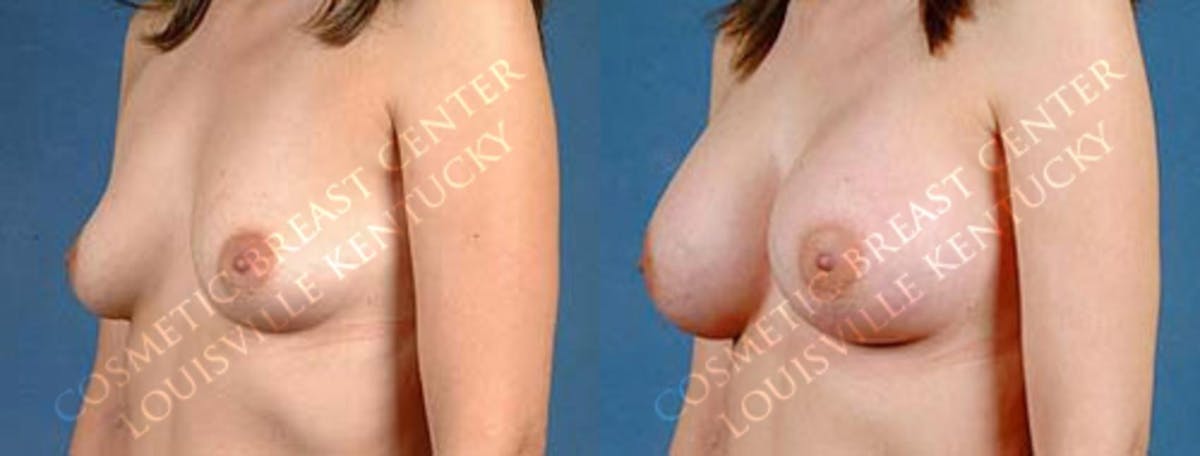 Enlargement - Saline Before & After Gallery - Patient 285940 - Image 2
