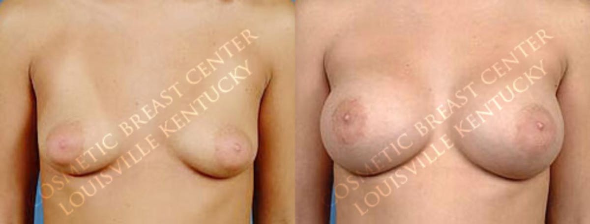 Enlargement - Saline Before & After Gallery - Patient 257503 - Image 1