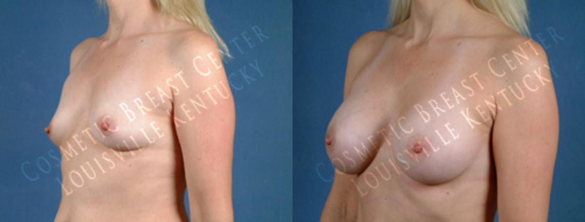 Enlargement - Saline Before & After Gallery - Patient 532741 - Image 2