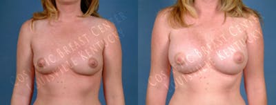 Enlargement - Saline Before & After Gallery - Patient 283004 - Image 1